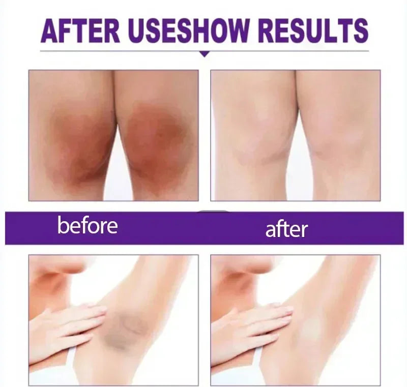 Skin Whitening Cream for Dark Skin Lightening Private Parts Whitening Cream  Arm Thigh Body Knees Whitening Brighten Skin Mild